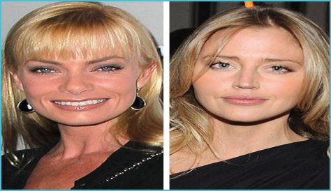 Estella Warren Plastic Surgery Before and After
