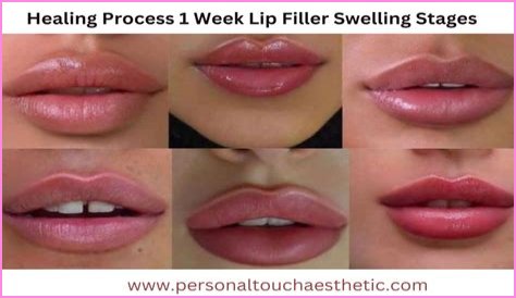 How Much Is Lip Filler Chicago